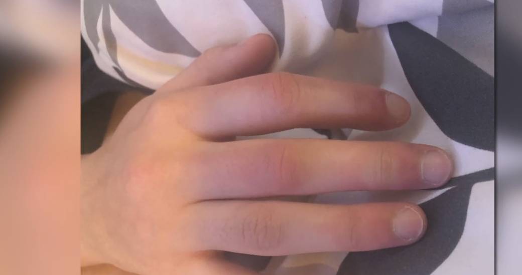 Click to play video: 'Frostbite warning from Spruce Grove family goes viral'