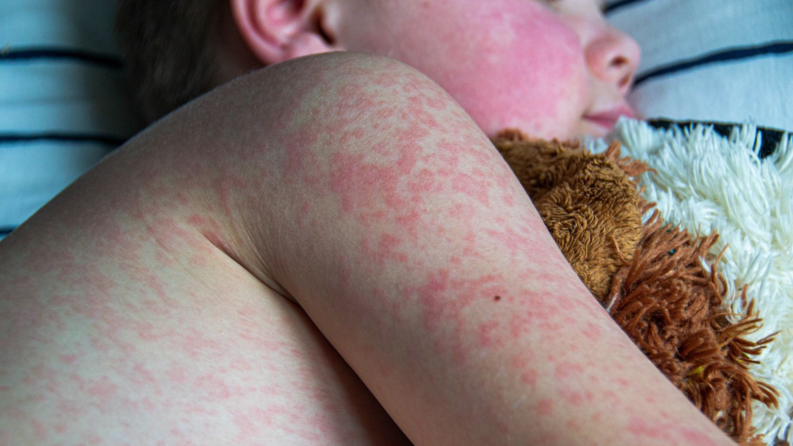 Measles rash on a child's body. File pic: iStock