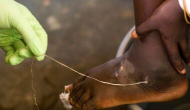 Guinea worm infections hit historic low of just 10 in 2025, Carter Center reports