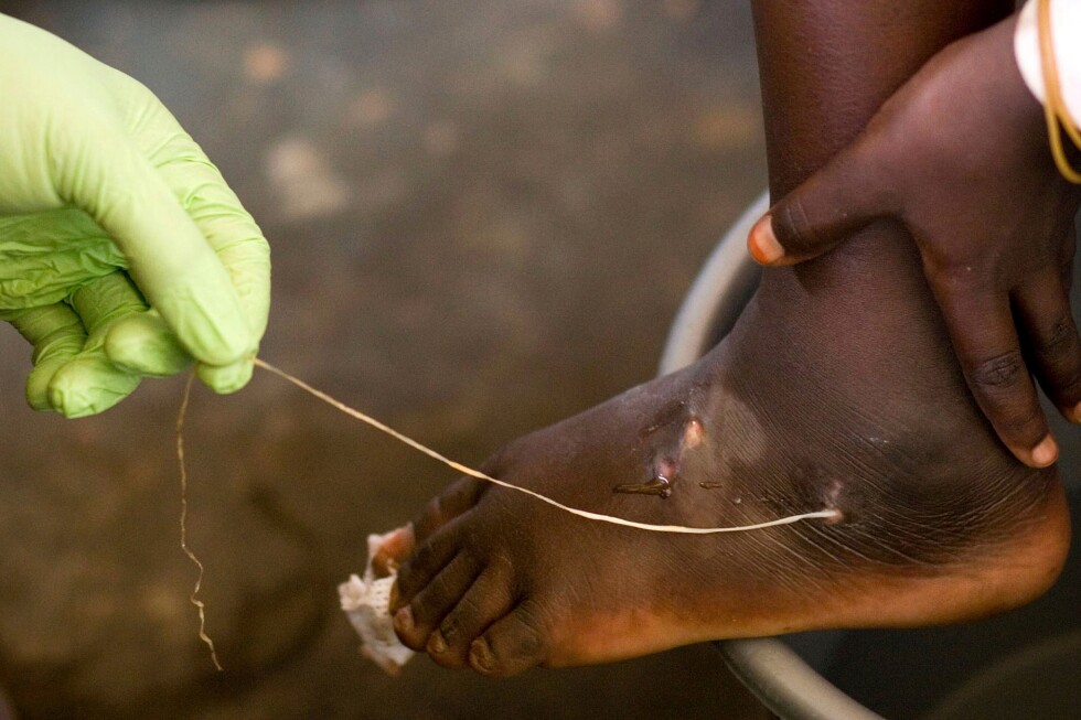 Guinea worm infections hit historic low of just 10 in 2025, Carter Center reports