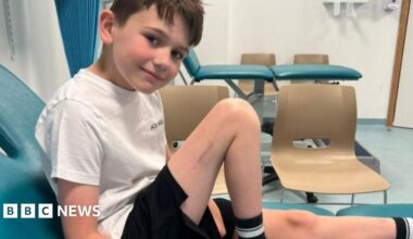 Alfie is sat on a hospital treatment bed with his right leg bent up. He is wearing a white t-shit and black shorts and is smiling at the camera.