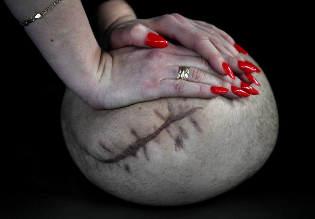 Sgt. Misha Varvarych, a Ukrainian war amputee, has the stump of his leg massaged