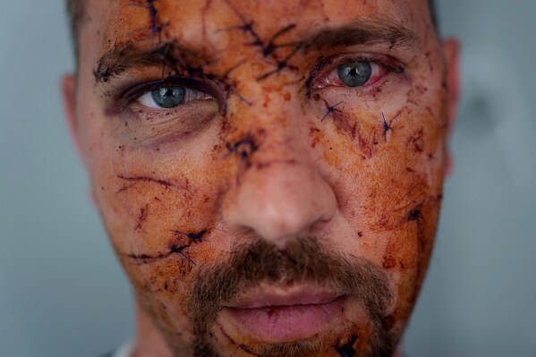 Multiple wounds can be seen on the face of Kostiantyn Bychek during a hospital visit in Kyiv, Ukraine, April 25, 2025. He was injured in a Russian strike. (AP Photo/Evgeniy Maloletka, File)