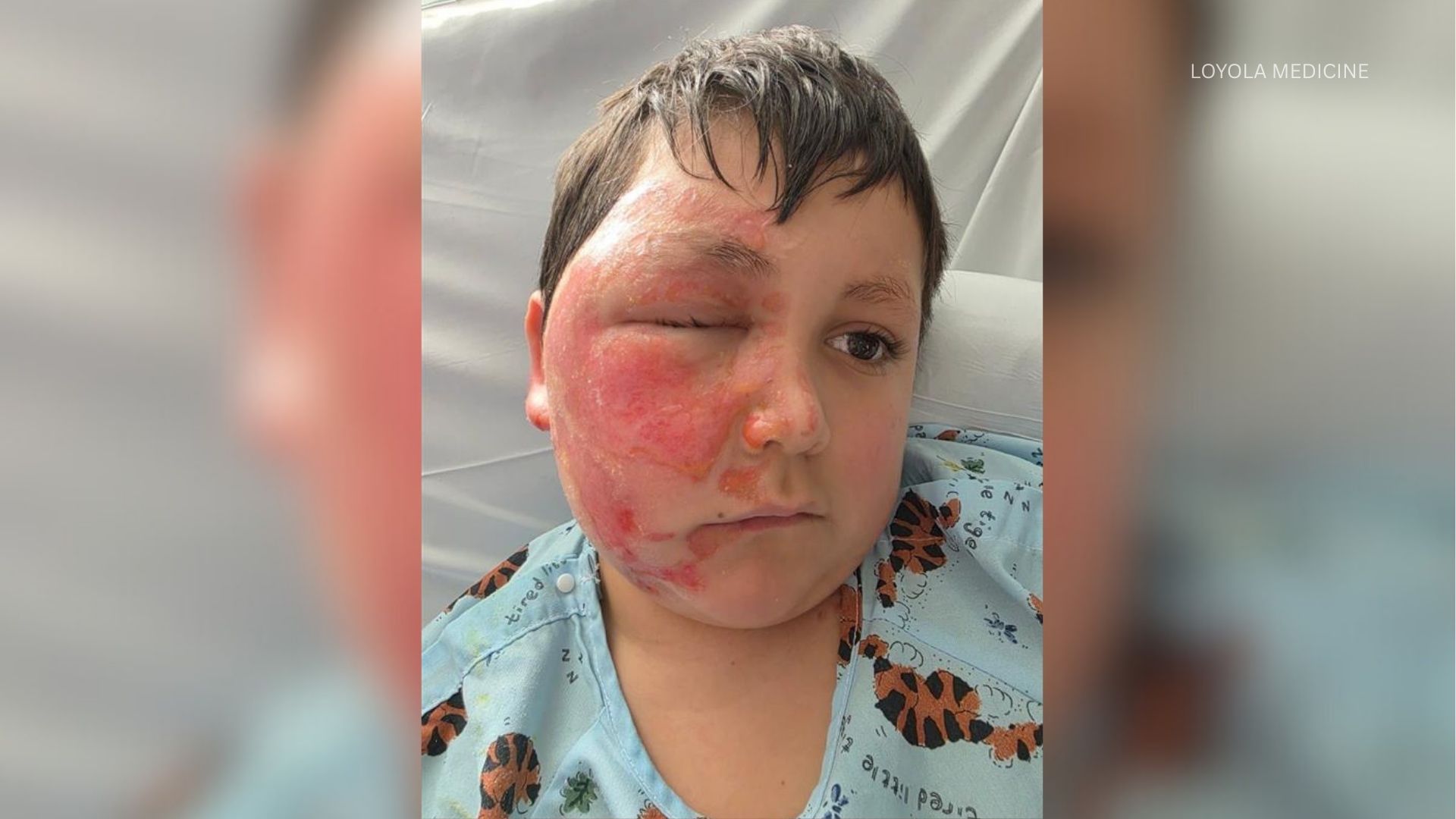 Nine-year-old Caleb was left with severe burns after following a TikTok video of people microwaving a toy to make it more pliable.