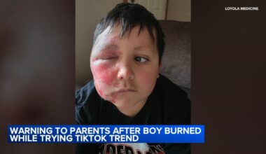 TikTok trend Needoh cube: Boy burned after social media trend; Loyola Medicine shares urgent warning