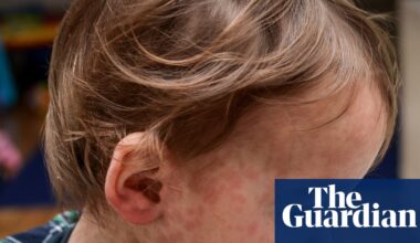 Measles: how does it spread and how can I protect my child? | Infectious diseases