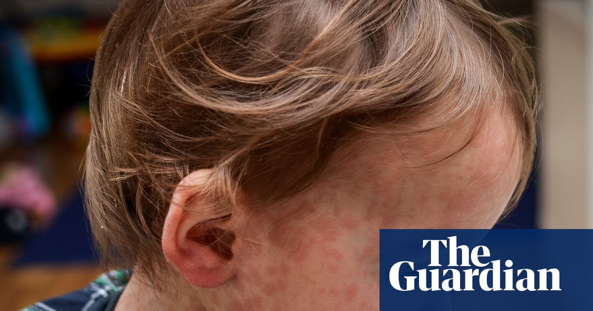 Measles: how does it spread and how can I protect my child? | Infectious diseases