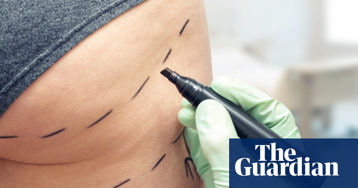 Brazilian butt lifts should be banned in UK amid ‘wild west’ industry, MPs say | Health