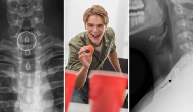 19-year-old’s bizarre beer pong injury required surgery to fix