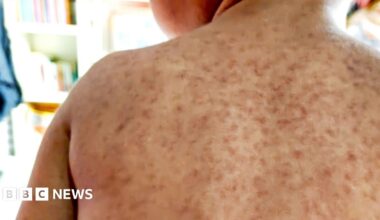 A child's back with a rash symptomatic of measles