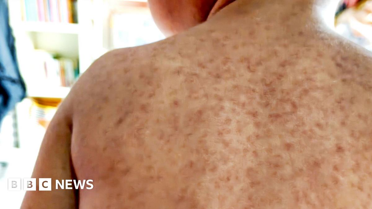 A child's back with a rash symptomatic of measles