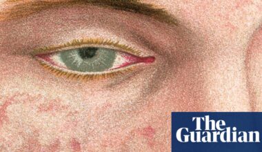 ‘We almost lost you in the night’ - the life-threatening rise of measles in the UK | Health