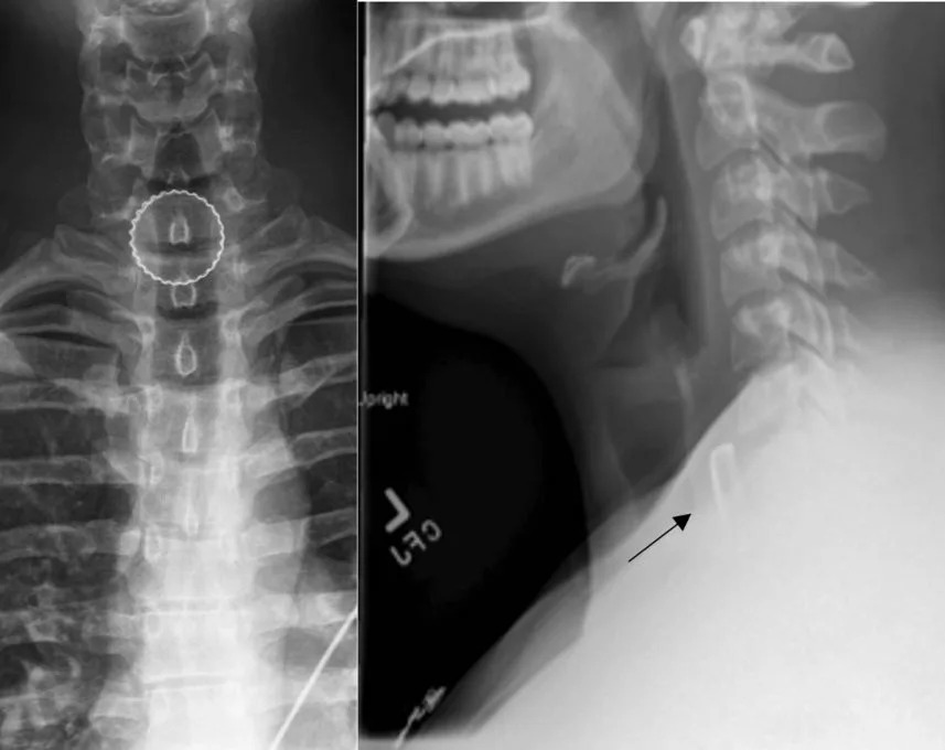 Despite having a stable airway, doctors had to use surgical intervention to remove the bottle cap due to the potential for damage or perforation. Cureus Journal of Medical Science