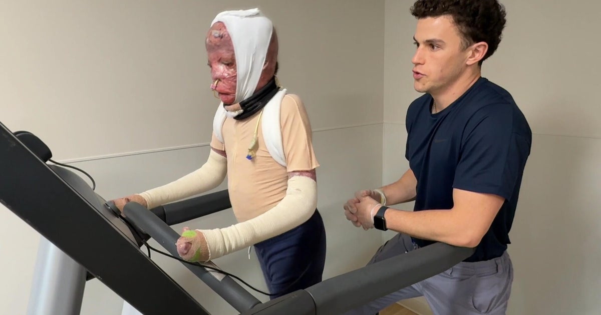 1 year after deadly Northeast Philadelphia plane crash, inside 10-year-old Ramesses' road to recovery