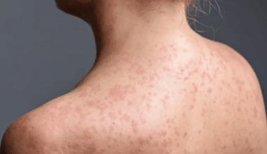 Measles outbreak hits north London schools as dozens of children infected - London Evening Standard