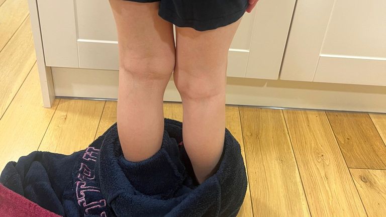 Alfie Phillips's knees before his leg-lengthening surgery at Alder Hay hospital. Pic: PA 