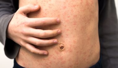 Measles is a highly infectious viral illness. Pic: iStock