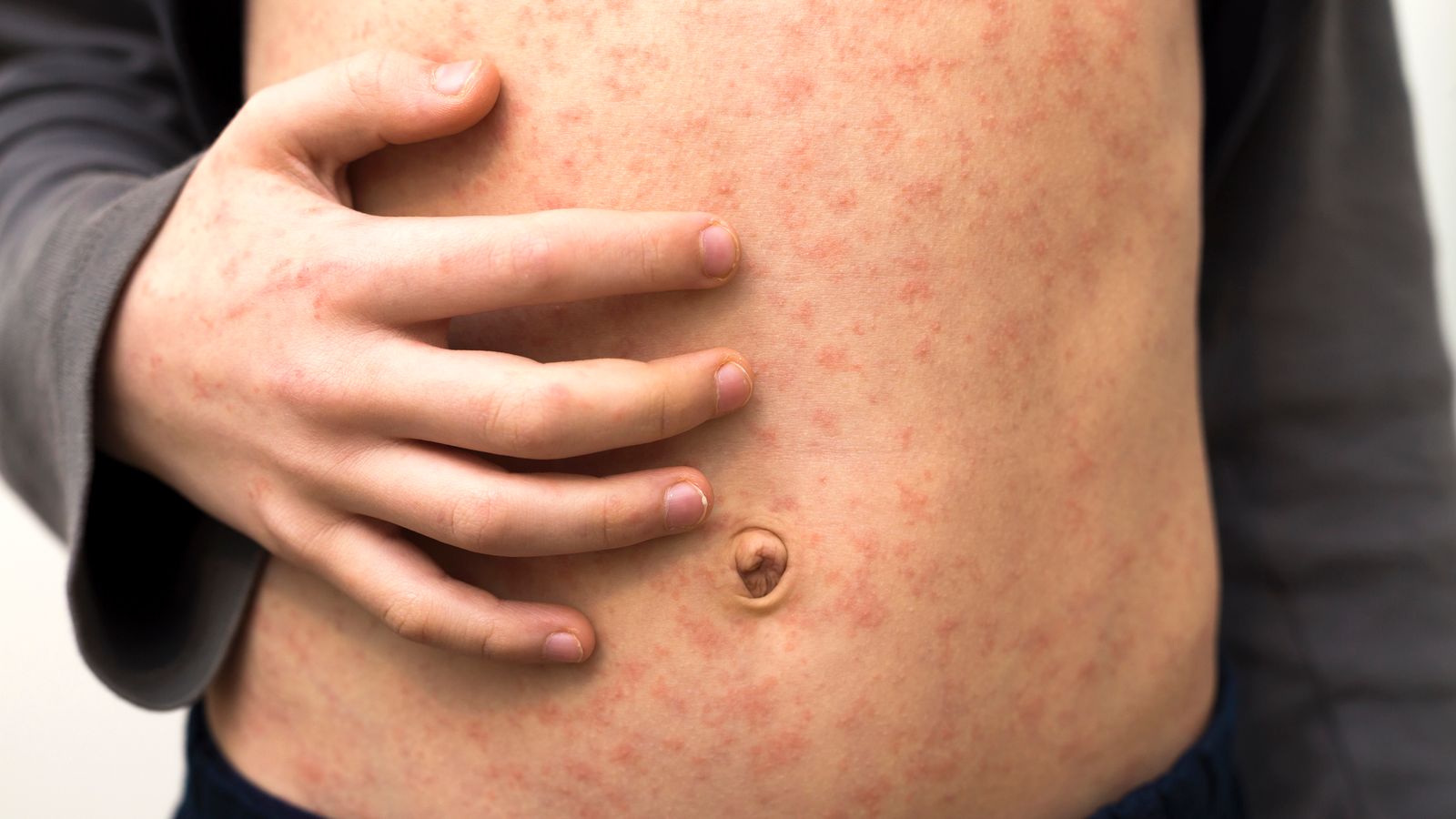 Measles is a highly infectious viral illness. Pic: iStock