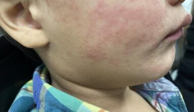 Winnipeg high school among latest measles exposure sites