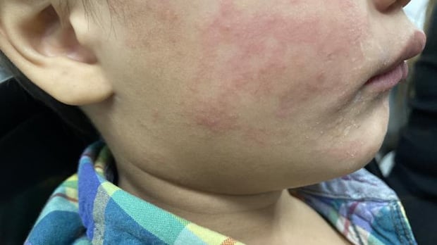 Winnipeg high school among latest measles exposure sites