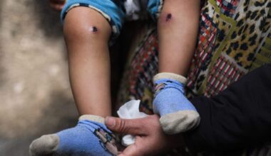 18-month-old Jawad Abu Nassar was returned by the Israeli army top his family with burn marks and puncture wounds, in what the family says was the result of torture, according to doctors, March 24, 2026. (Photo: Ramzi Abu Amer/APA Images)