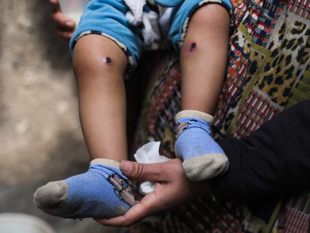 18-month-old Jawad Abu Nassar was returned by the Israeli army top his family with burn marks and puncture wounds, in what the family says was the result of torture, according to doctors, March 24, 2026. (Photo: Ramzi Abu Amer/APA Images)