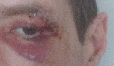 Toronton man says he was randomly punched in the face on the street