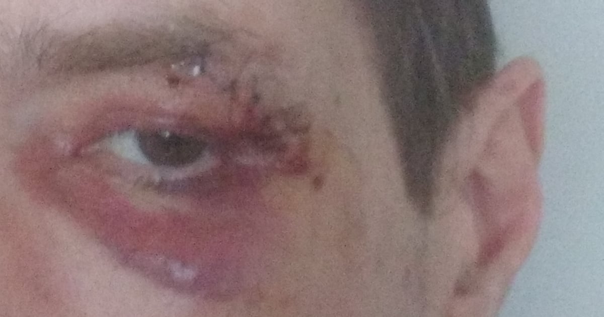 Toronton man says he was randomly punched in the face on the street