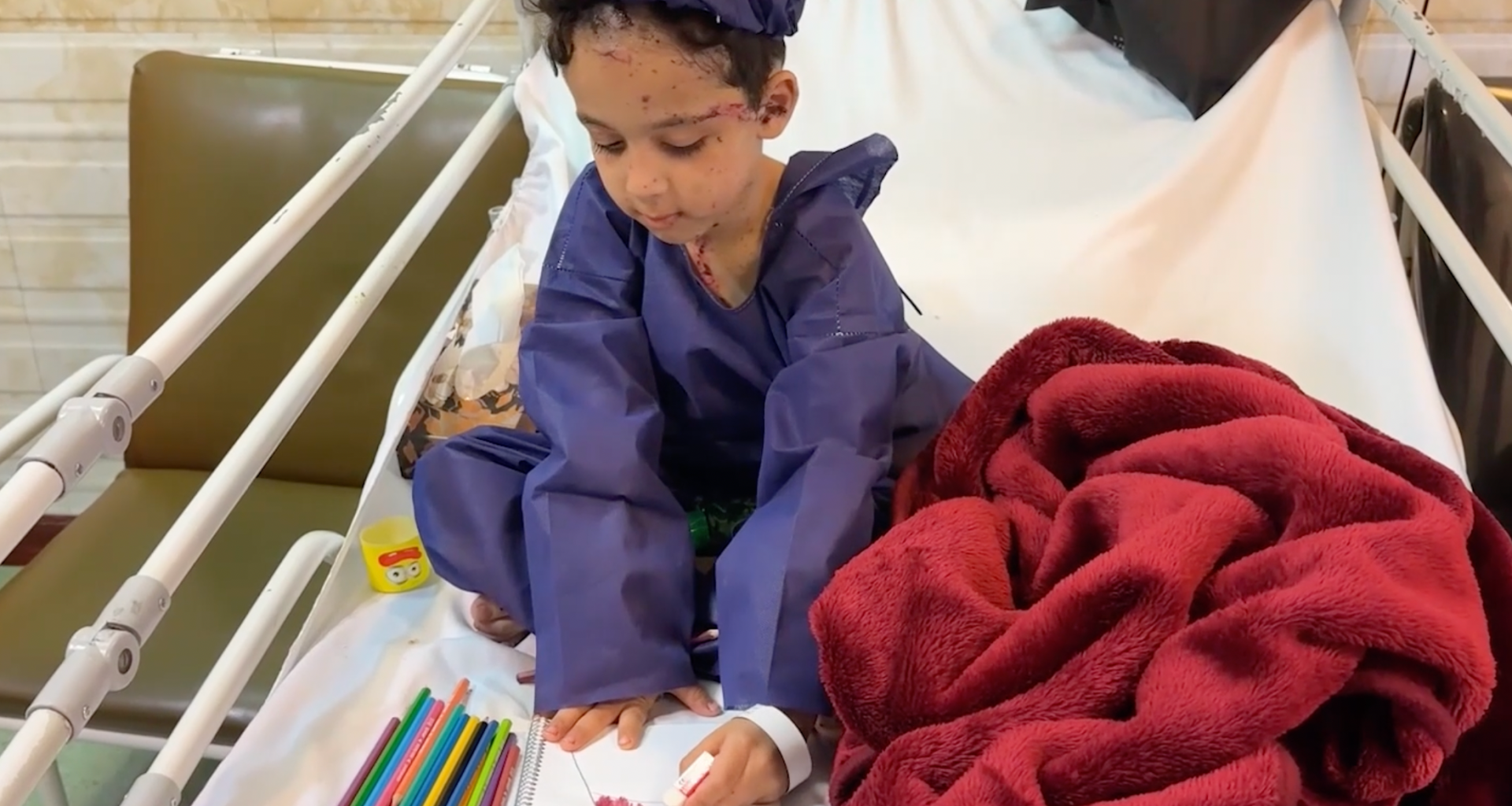Children wounded in the US-Israeli strikes receive treatment in Tehran | US-Israel war on Iran