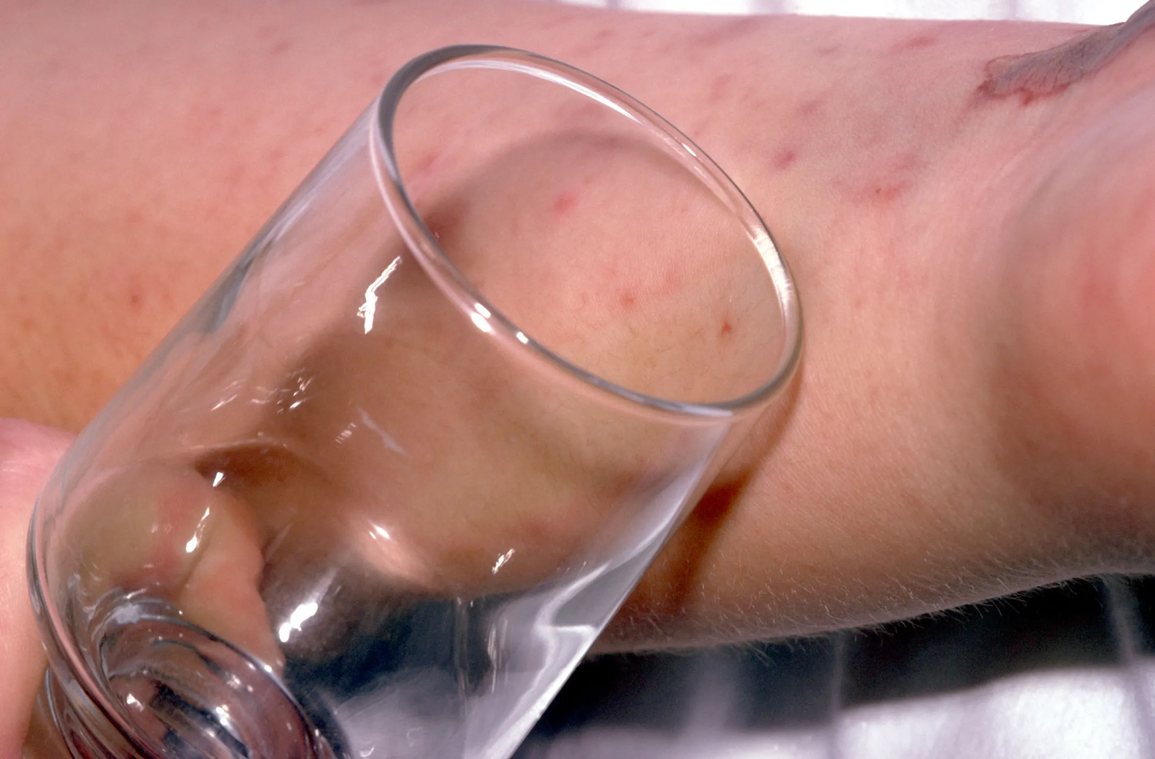 A purpuric rash, characteristic of meningitis, being tested with a glass pressed against the skin.