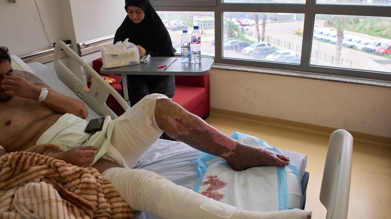A man with burn wounds from an Israeli airstrike on...