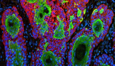 Replimune skin cancer drug that became FDA flashpoint is rejected again