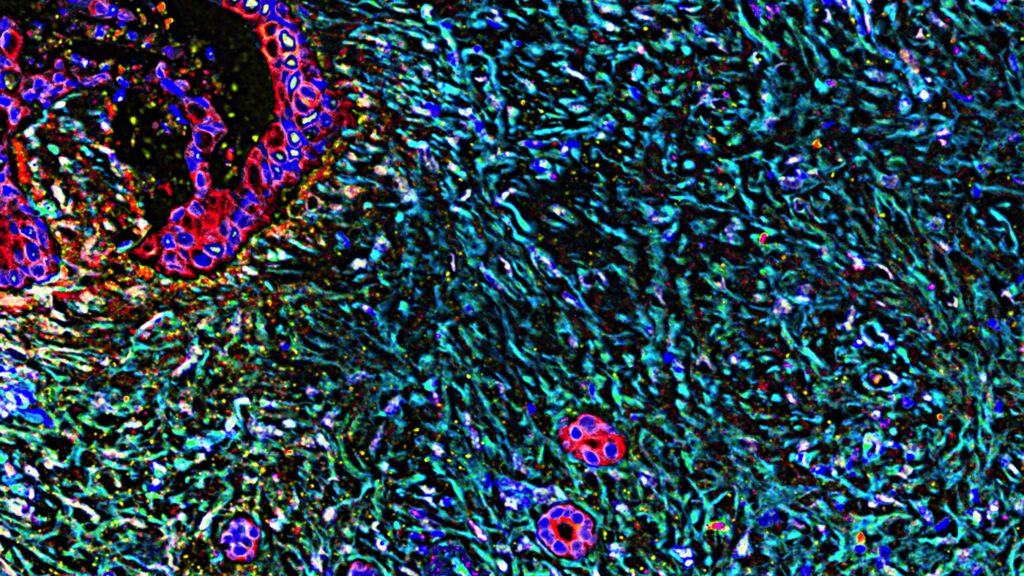 Erasca touts strong early results in pancreatic and lung cancer therapy trial