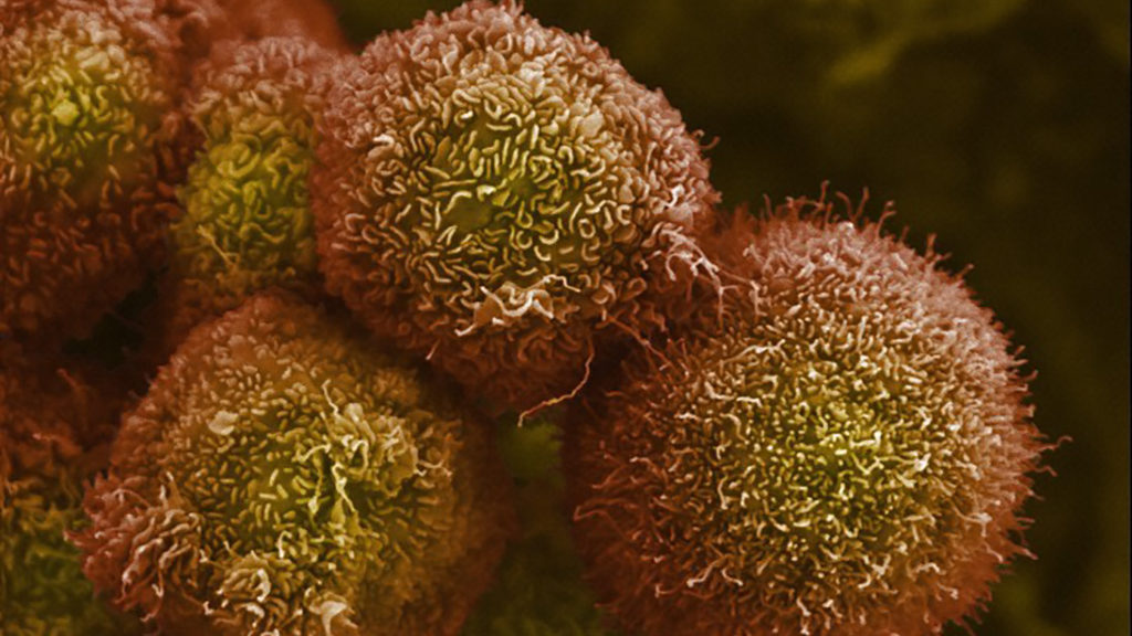 Revolution Medicines touts success in pancreatic cancer treatment