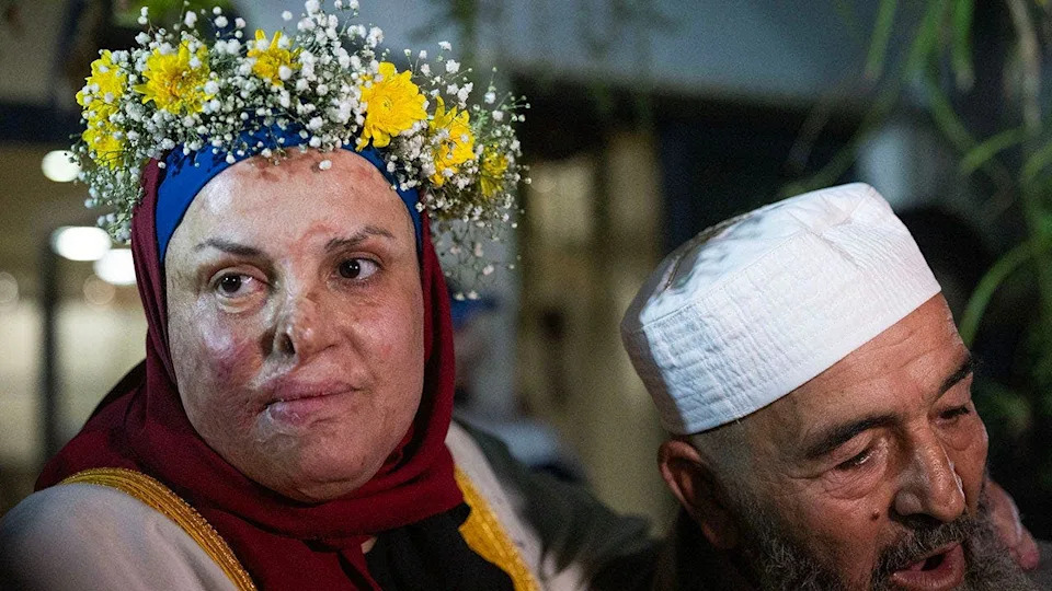 Palestinian prisoner Israa Jaabis arriving at her home in east Jerusalem