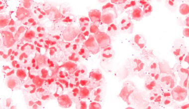 Dangerous bacterial infection hits highest level seen in Canada in more than a decade