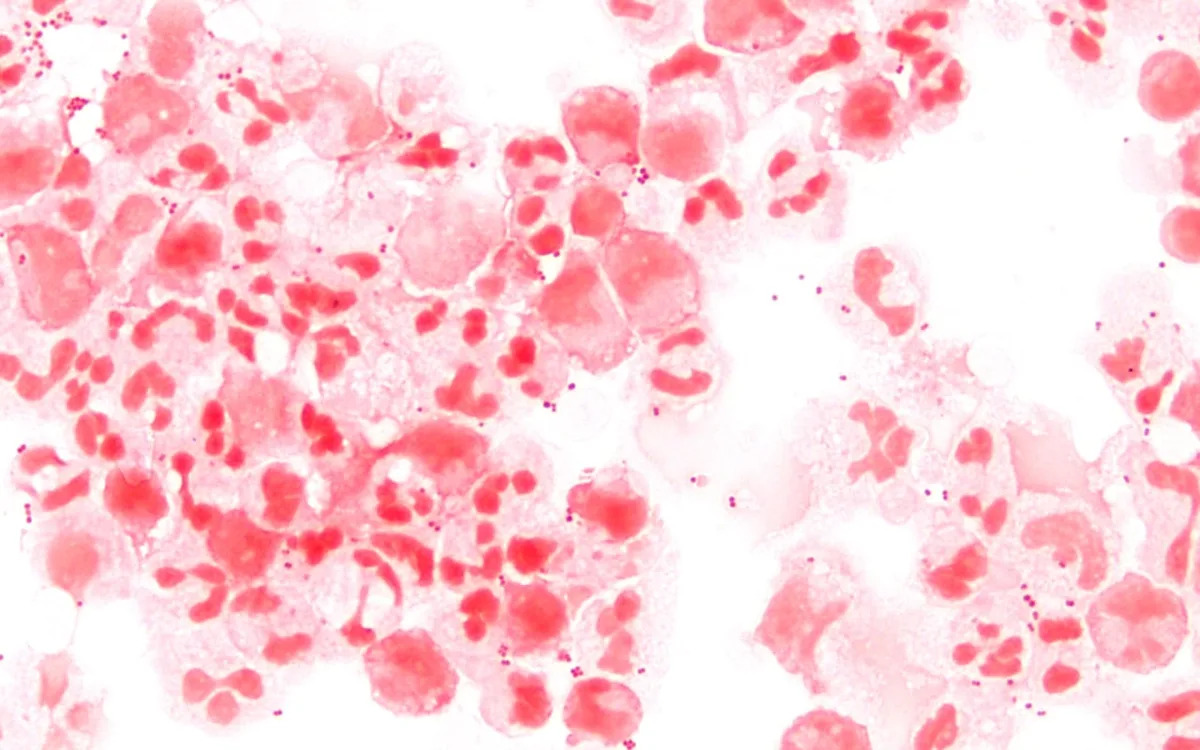 Dangerous bacterial infection hits highest level seen in Canada in more than a decade