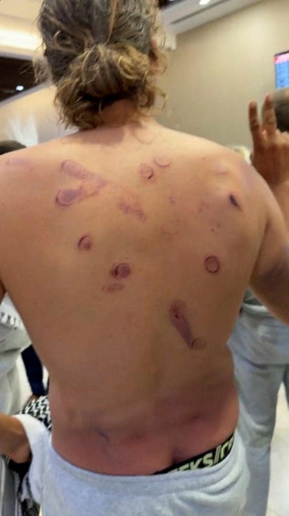 The injuries of an Italian activist, who said they were caused by guards at the detention facility, who reportedly kicked and pushed them if they moved or spoke, Thursday. Credit: Gaza Freedom Flotilla/Reuters The injuries of an Italian activist, who said they were caused by guards at the detention facility, who reportedly kicked and pushed them if they moved or spoke, Thursday.