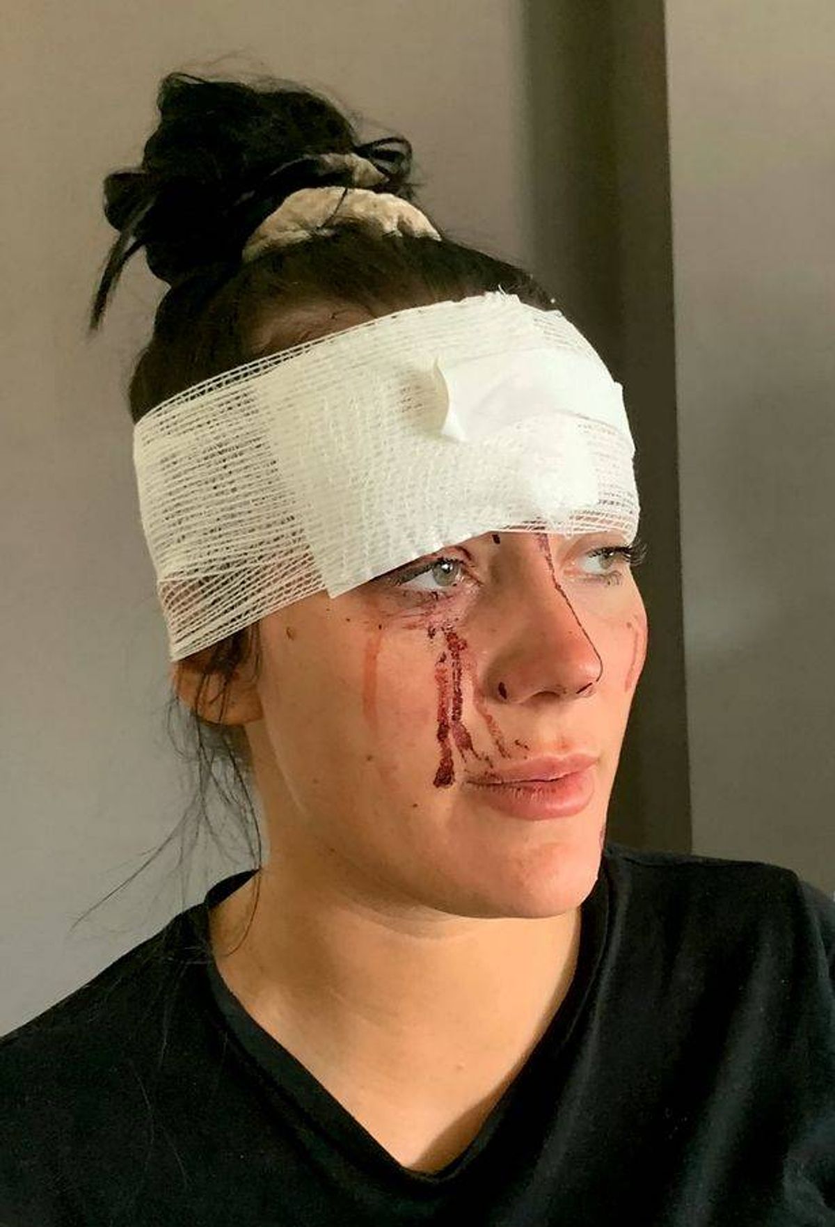 An individual is depicted with a white bandage wrapped around their head, suggesting a recent injury. The bandage is covering an area above the right eye, with visible signs of a laceration and a slight tear in the skin. The person appears to be in distress, evident by their emotional state and the tear streaks on their face. The setting is a plain, light-colored background, drawing attention to the individual's condition.