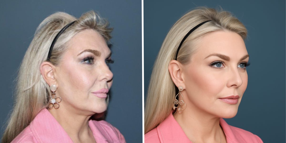 AI Images Are Distorting Plastic Surgery Expectations