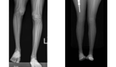 Israeli doctors use 3D printer to lengthen woman's leg for vanishing bone disease