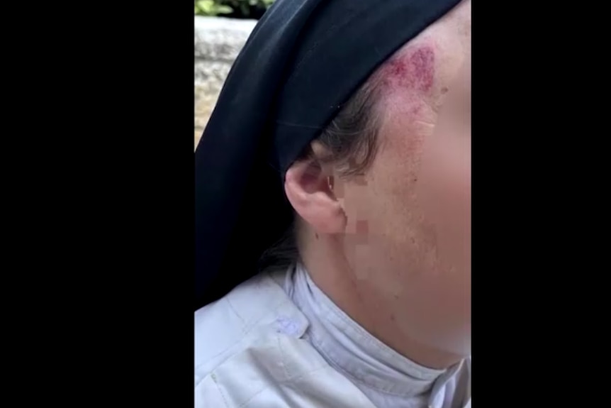 This picture shows a bruise on the right side of a nun's face.