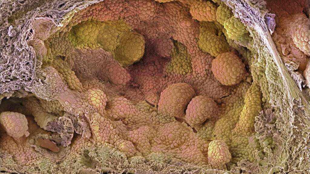 New hormone protocol cut relapse risk in prostate cancer trial