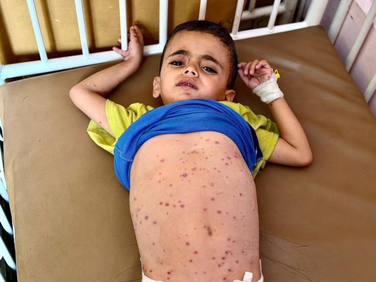 Six-year-old Yasser Arafat in a hospital bed in Nasser Hospital, Khan Younis