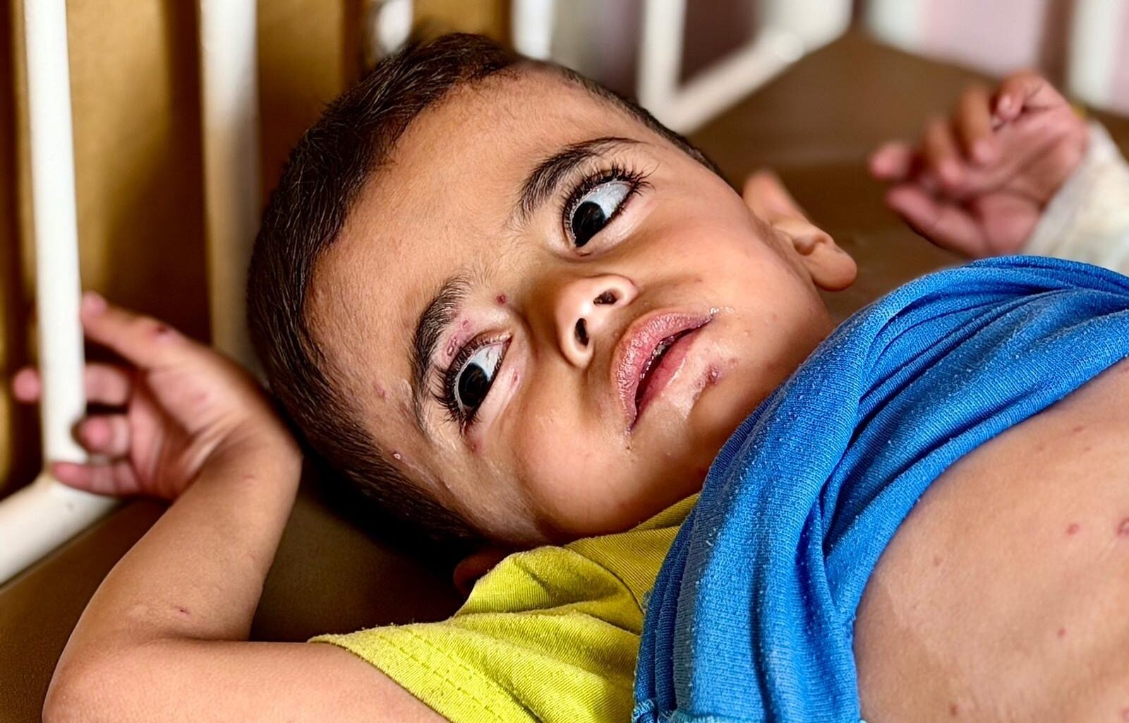 Burn-like rashes and hunger: Gaza’s children face skin disease crisis | Israel-Palestine conflict News