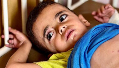 Burn-like rashes and hunger: Gaza’s children face skin disease crisis | Israel-Palestine conflict News