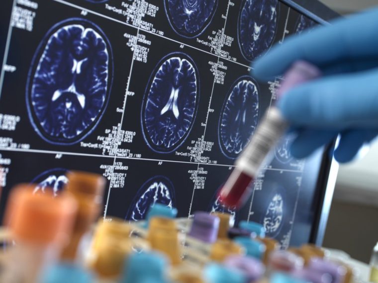 A scientist holds a test tube of blood, in front of brain scans