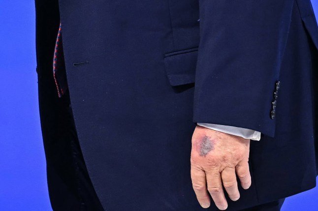 TOPSHOT - A bruise is visible on the back of US President Donald Trump's left hand as he walks at the "Board of Peace" meeting during the World Economic Forum (WEF) annual meeting in Davos on January 22, 2026. US President Donald Trump will show off his new "Board of Peace" at Davos on January 22, 2026 burnishing his claim to be a peacemaker a day after backing off his own threats against Greenland. Originally meant to oversee the rebuilding of Gaza after the war between Hamas and Israel, the board's charter does not limit its role to the Strip, and has sparked concerns that Trump wants it to rival the United Nations. (Photo by Fabrice COFFRINI / AFP via Getty Images)
