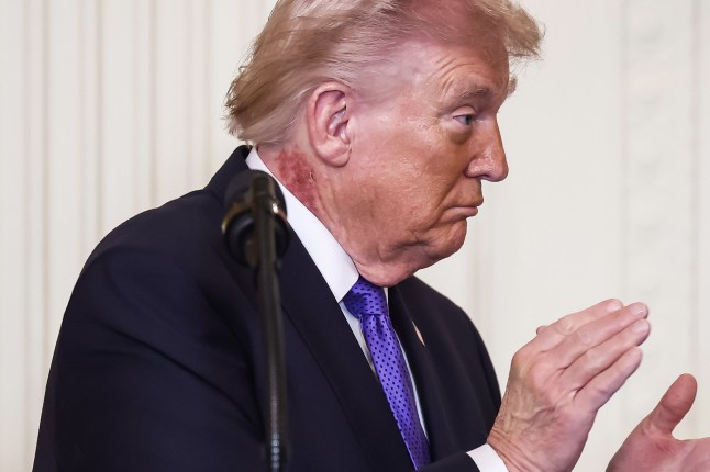 epa12790483 US President Donald Trump attends a medal of honor ceremony in the East Room of the White House in Washington, DC, USA, 02 March 2026. The President has a red rash on the right side of his neck. EPA/JIM LO SCALZO / POOL