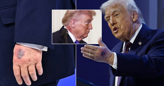 DAVOS, SWITZERLAND - JANUARY 22: A bruise can be seen on the back of U.S. President Donald Trump's left hand during a signing ceremony for the ???????Board of Peace??????? at the World Economic Forum (WEF) on January 22, 2026 in Davos, Switzerland. The US-backed ???????Board of Peace??????? is intended to administer the fragile ceasefire in the Gaza Strip after the war between Israel and Hamas. The final makeup of the board has not been confirmed. (Photo by Chip Somodevilla/Getty Images)